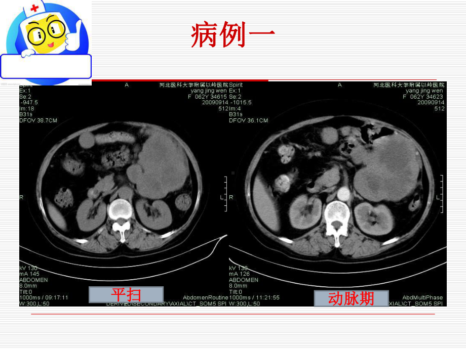 胃肠道间质瘤的影像诊疗培训课件-2.ppt_第3页