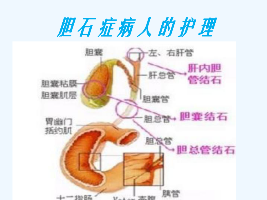 胆石症病人护理课件.ppt_第1页