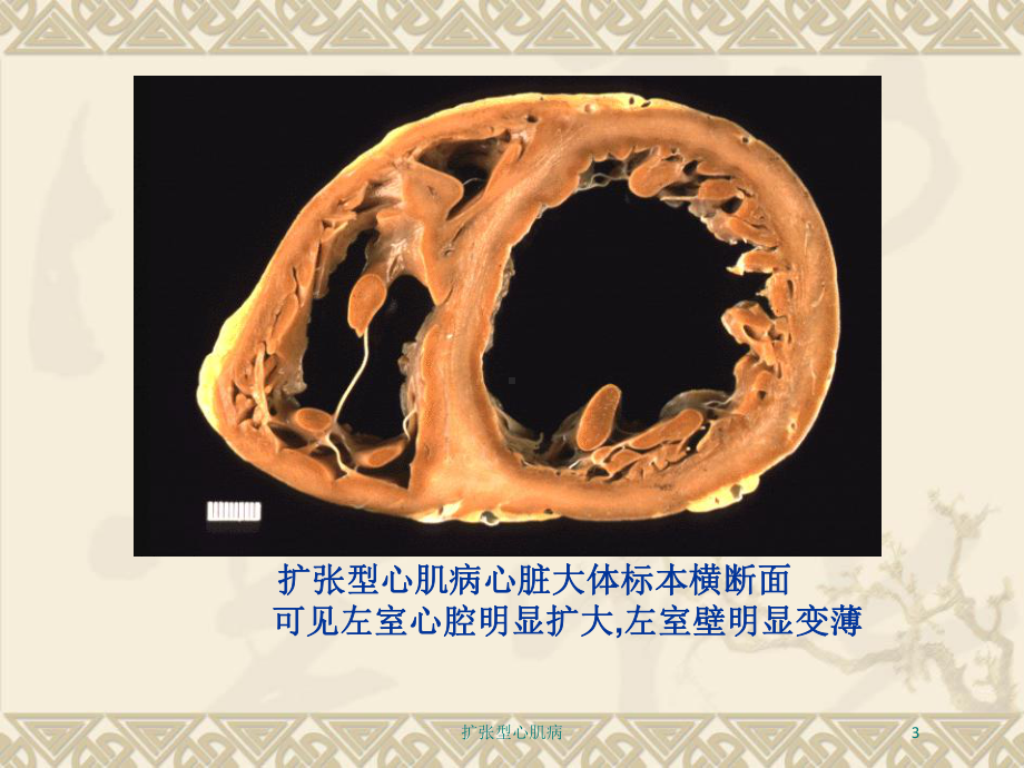 扩张型心肌病培训课件2.ppt_第3页