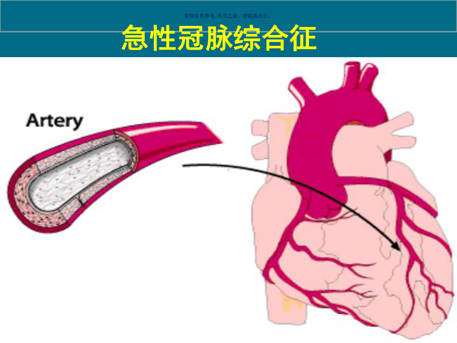 遵循指南积极管理ACS不稳定心绞痛课件.ppt_第1页