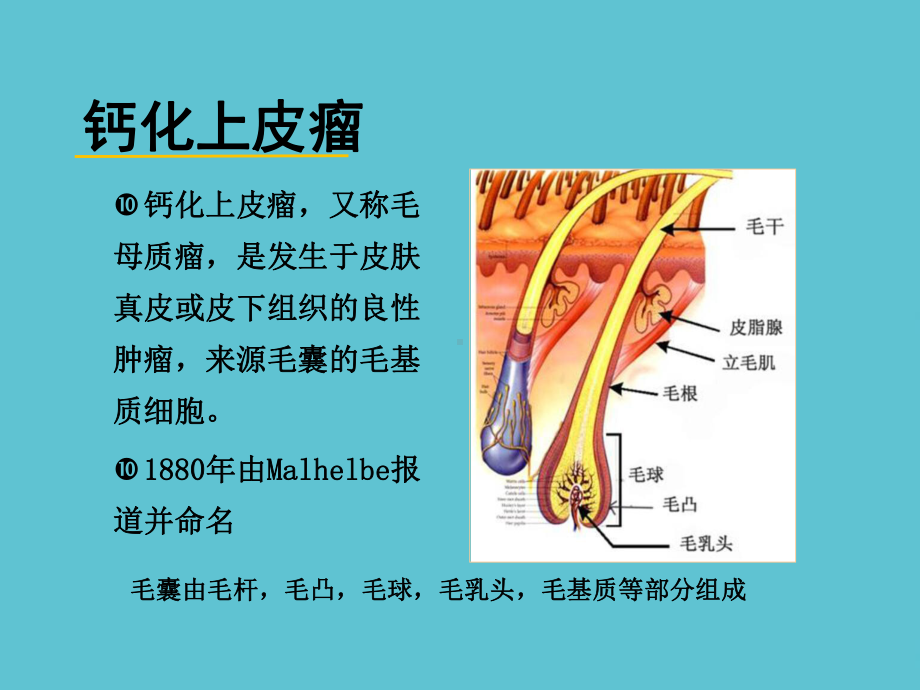 钙化上皮瘤的超声诊断课件.ppt_第2页