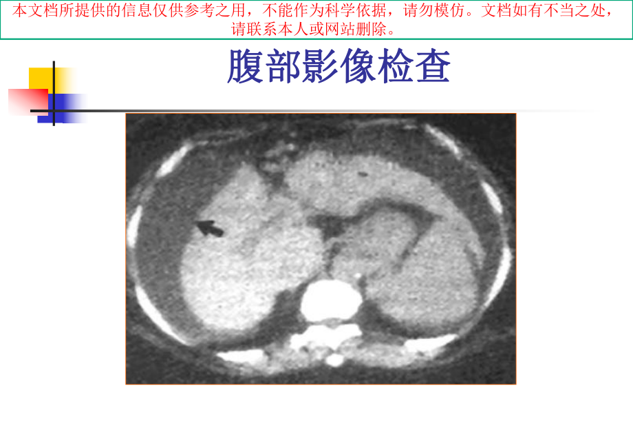 腹水的诊断以鉴别诊断培训课件.ppt_第3页