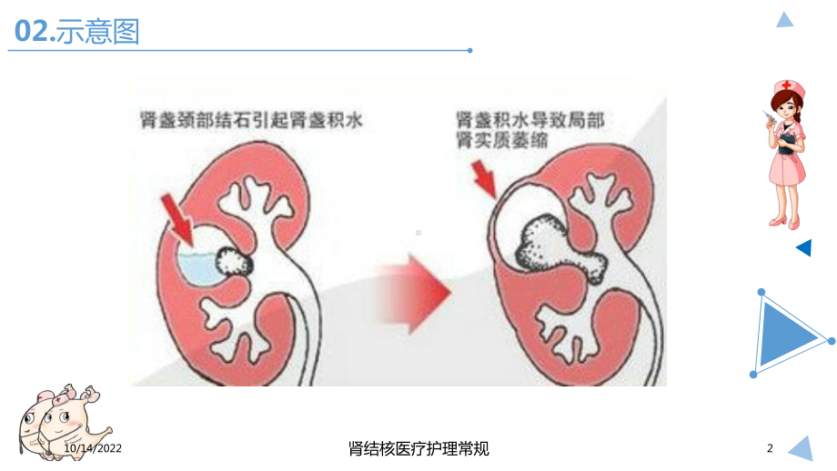 肾结核医疗护理常规培训课件.ppt_第2页