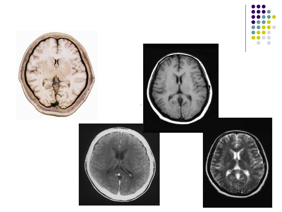 脑室扩大影像诊断课件.pptx_第2页