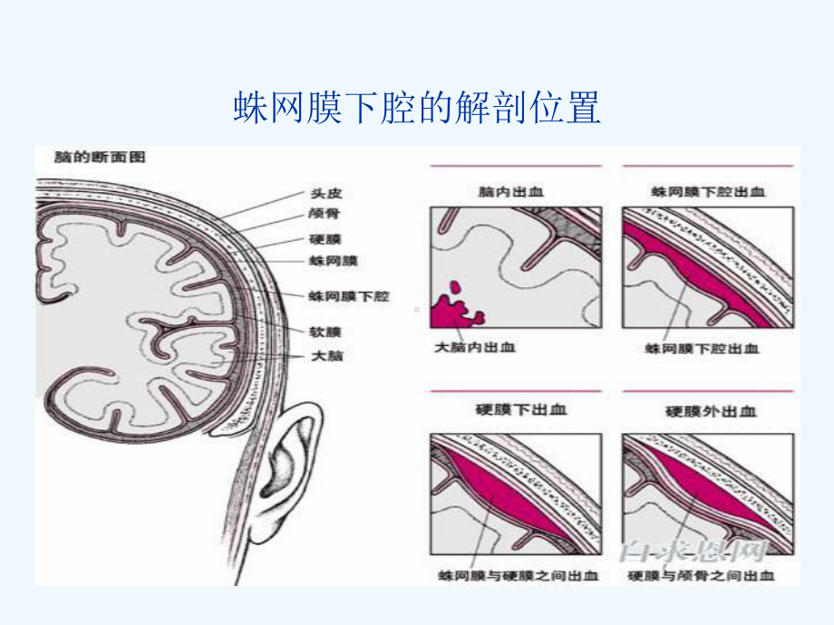 蛛网膜下腔出血病人护理课件.ppt_第3页