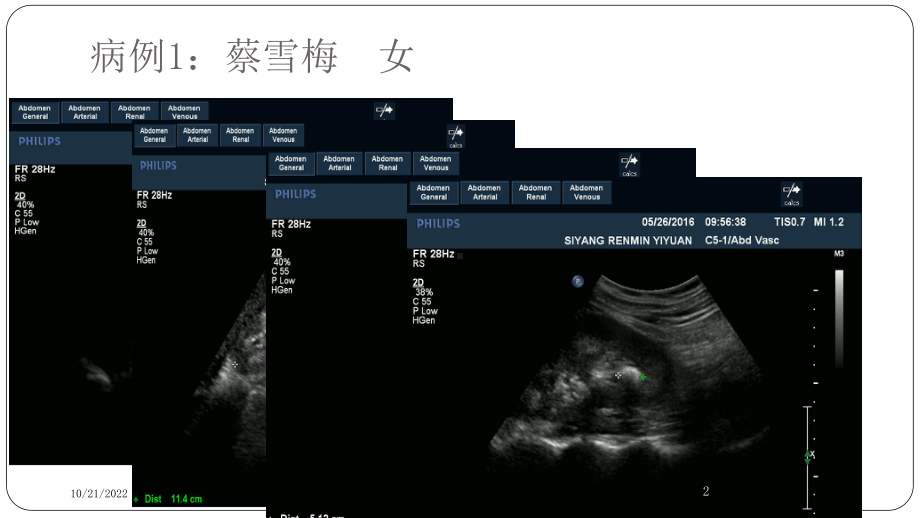 肾钙质沉着症培训课件.ppt_第2页