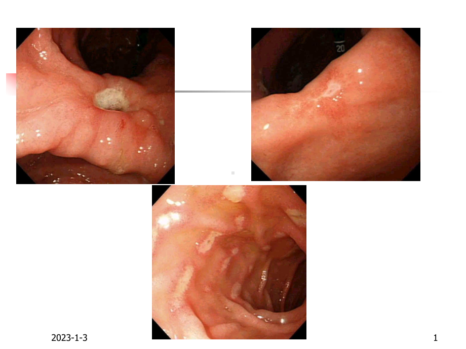 消化性溃疡新课件.ppt_第1页