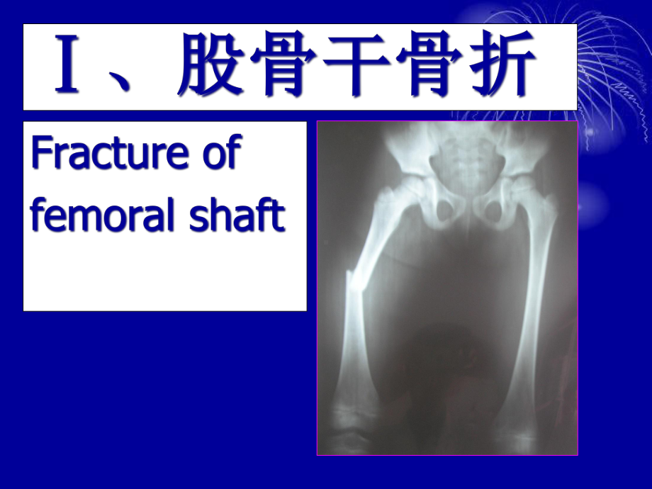 闭合复位应用磁力导航交锁髓内针内固定股骨干骨折课件.ppt_第2页