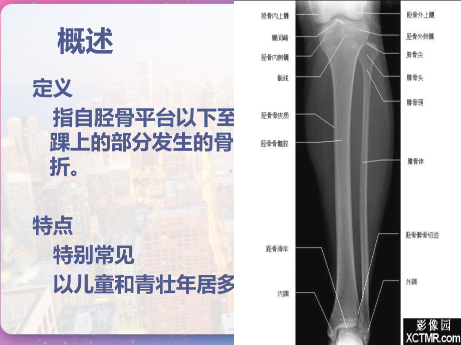 胫腓骨骨折的护理-课件.pptx_第3页