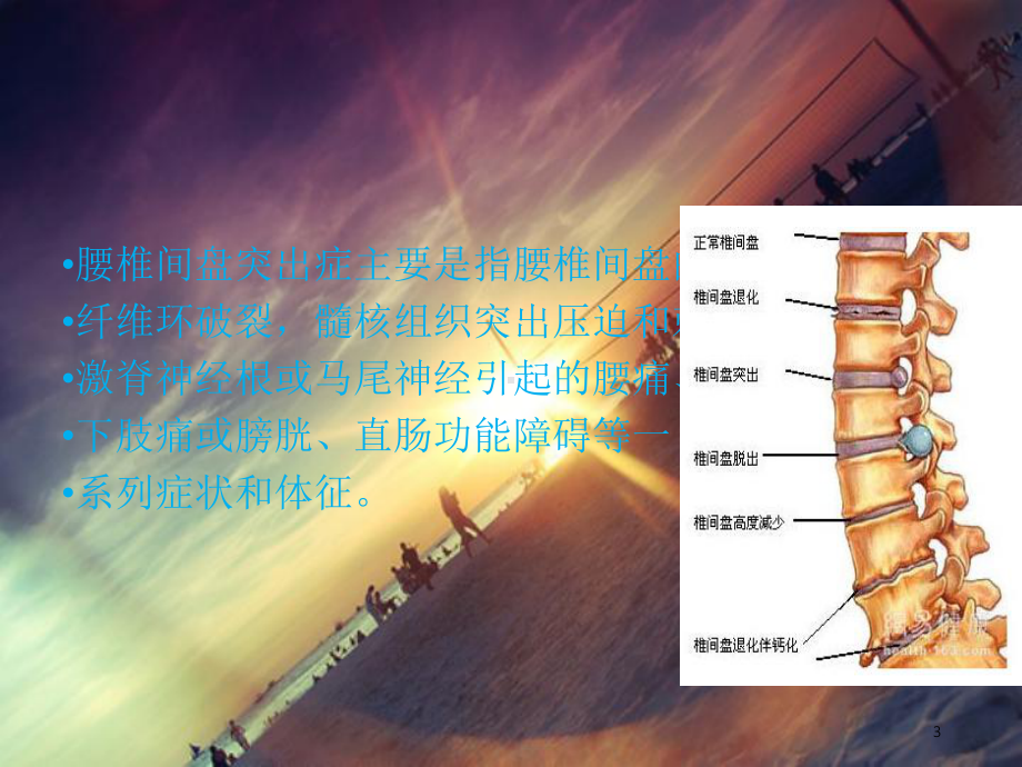 腰椎间盘突出症评定课件.ppt_第3页