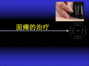 面瘫治疗医学课件.ppt