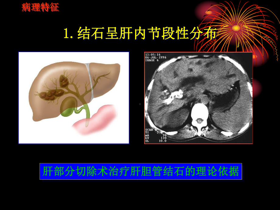 胆管结石手术方式课件.ppt_第3页