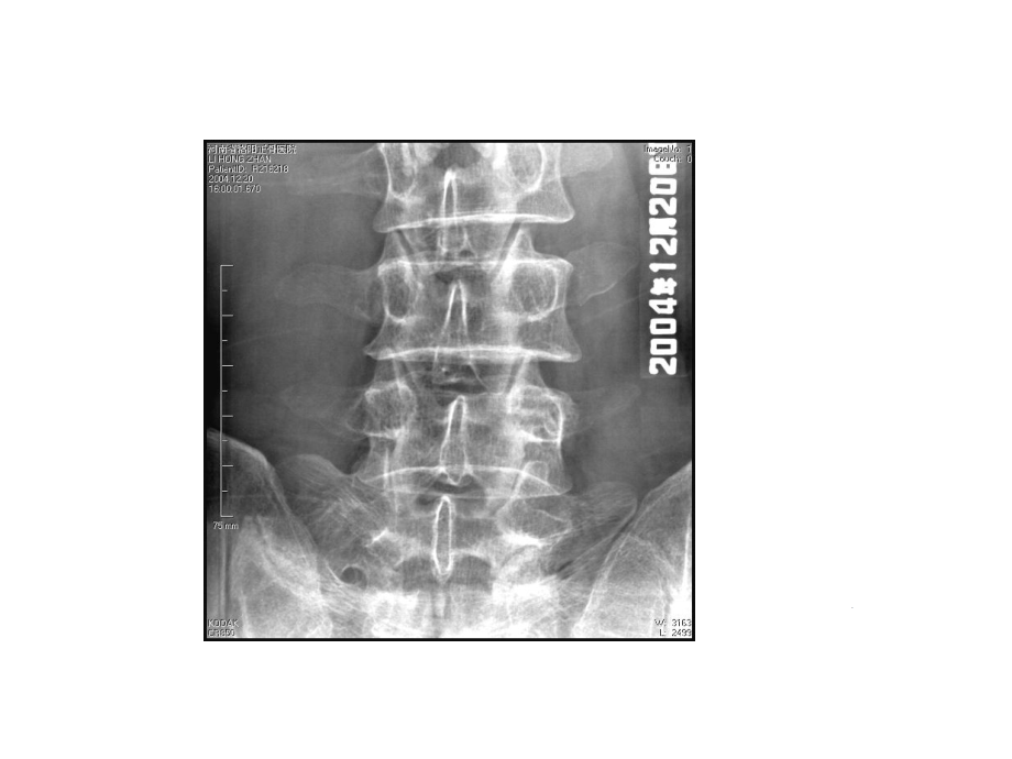 腰椎退变专业知识讲座培训课件.ppt_第3页