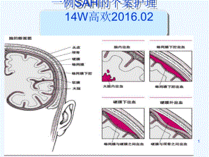 蛛网膜下腔出血个案护理课件.ppt