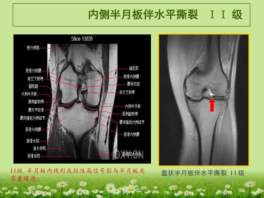 膝关节韧带MRI损伤表现教学课件.ppt_第3页