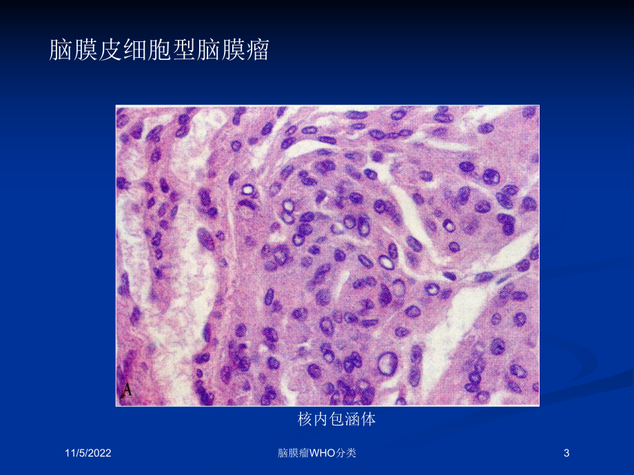 脑膜瘤WHO分类培训课件.ppt_第3页