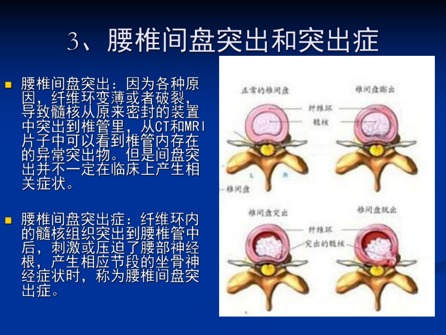 腰间盘突出症的康复治疗主题讲座课件.ppt_第3页