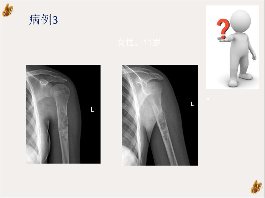 非骨化性纤维瘤的x线诊断及鉴别诊断课件-2.pptx_第1页