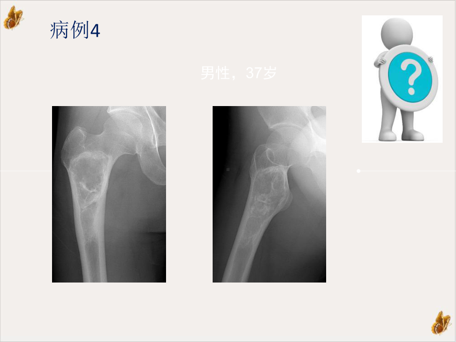 非骨化性纤维瘤的x线诊断及鉴别诊断课件-2.pptx_第2页