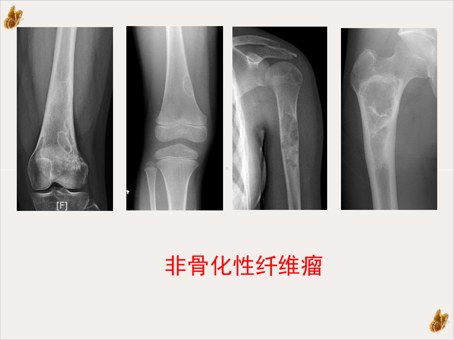 非骨化性纤维瘤的x线诊断及鉴别诊断课件-2.pptx_第3页