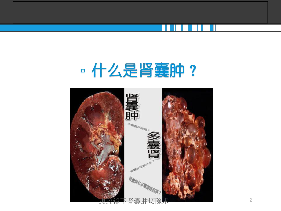 腹腔镜下肾囊肿切除术培训课件.ppt_第2页