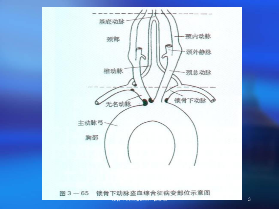 锁骨下动脉盗血综合征新版培训课件.ppt_第3页