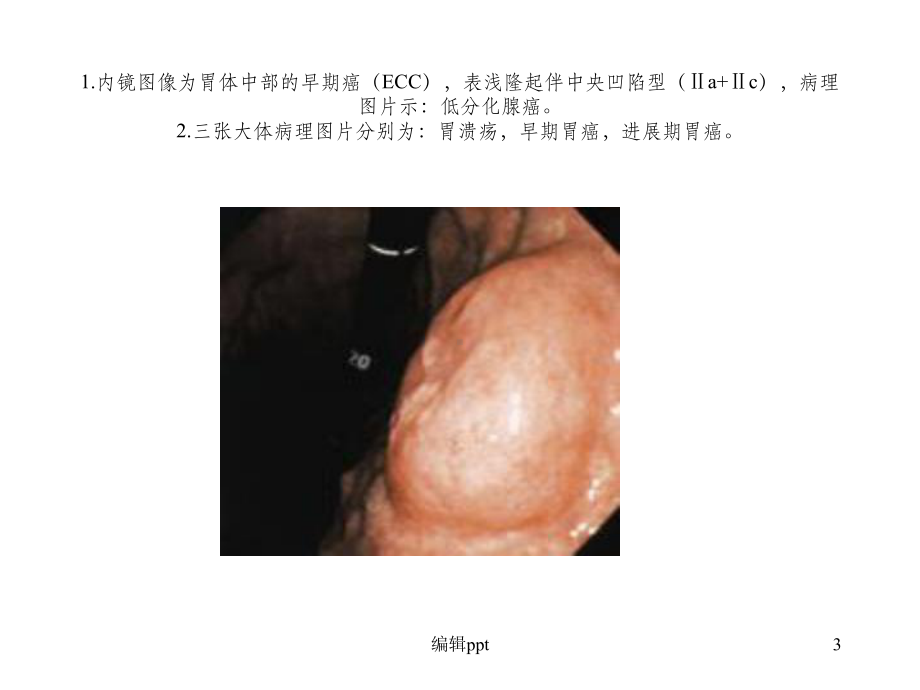 早期胃癌的-胃镜表现课件.ppt_第3页