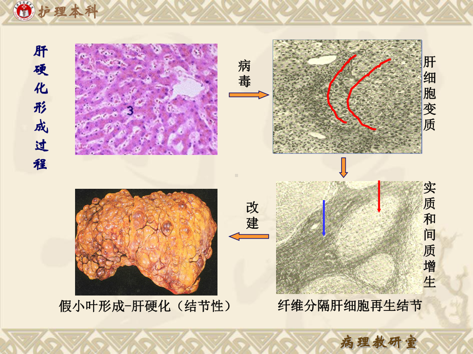 病理学肝硬化肝癌课件.ppt_第2页