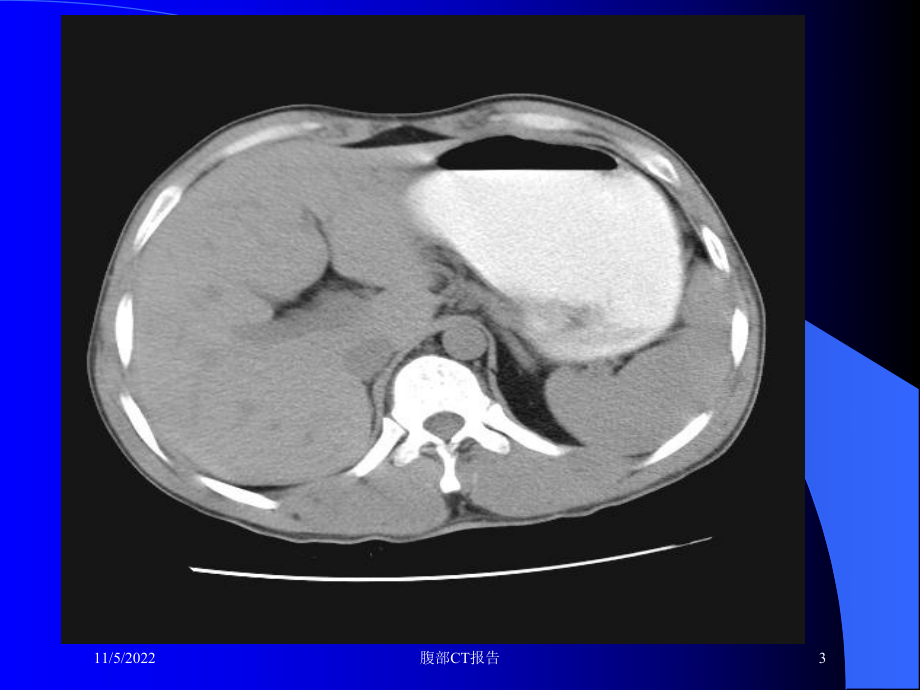 腹部CT报告培训课件.ppt_第3页