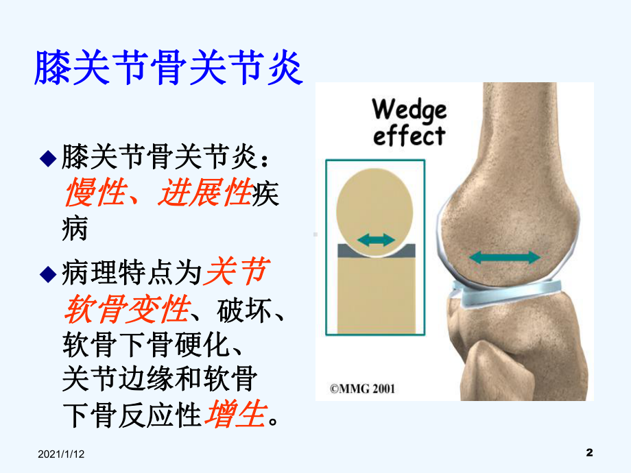 膝骨关节炎的防治课件.ppt_第2页