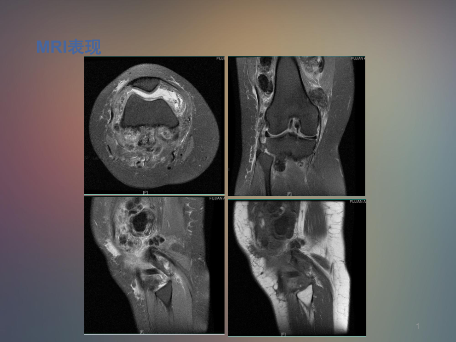 色素沉着绒毛结节性滑膜炎课件.ppt_第1页