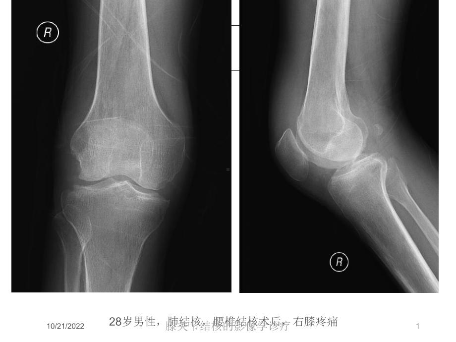 膝关节结核的影像学诊疗培训课件.ppt_第1页