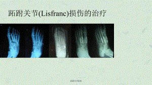 跖跗关节损伤课件.ppt