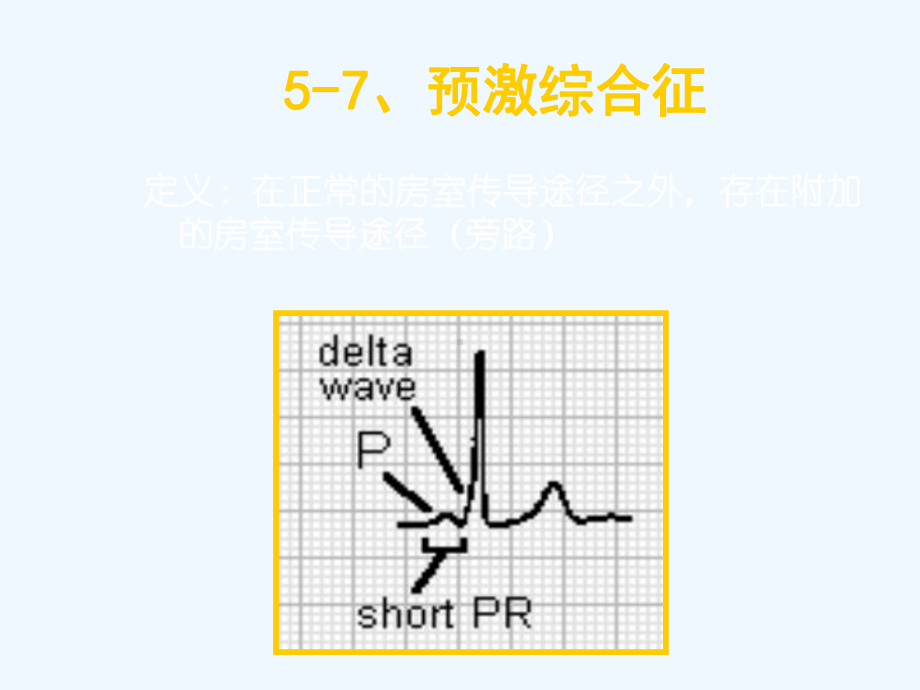 预激综合征和逸搏课件.ppt_第2页