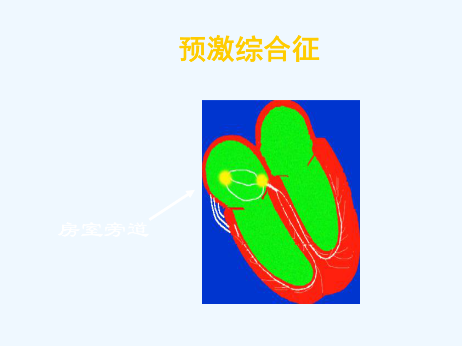 预激综合征和逸搏课件.ppt_第3页