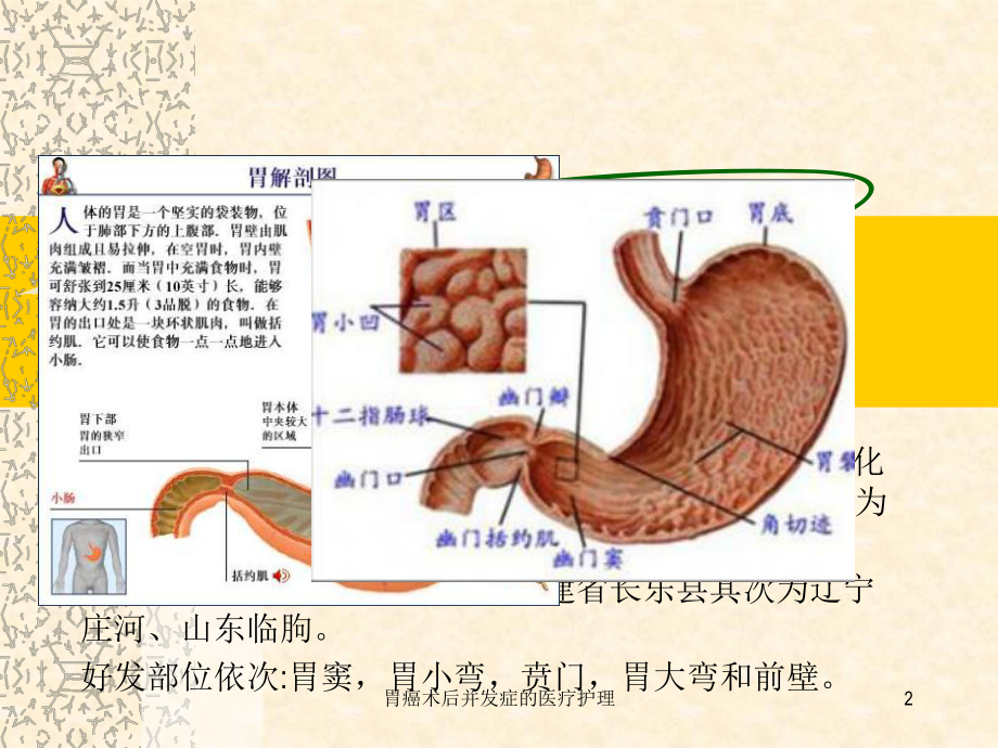 胃癌术后并发症的医疗护理培训课件.ppt_第2页