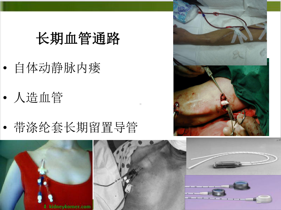 血管通路系列人造血管内瘘示范课件.ppt_第2页