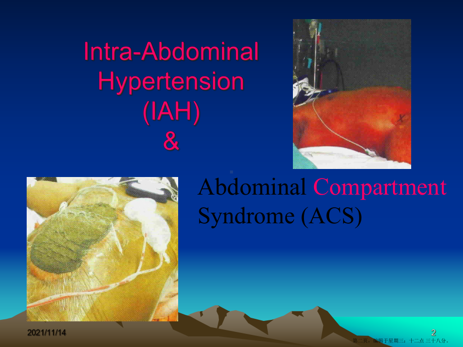腹腔间室综合征课件.ppt_第2页