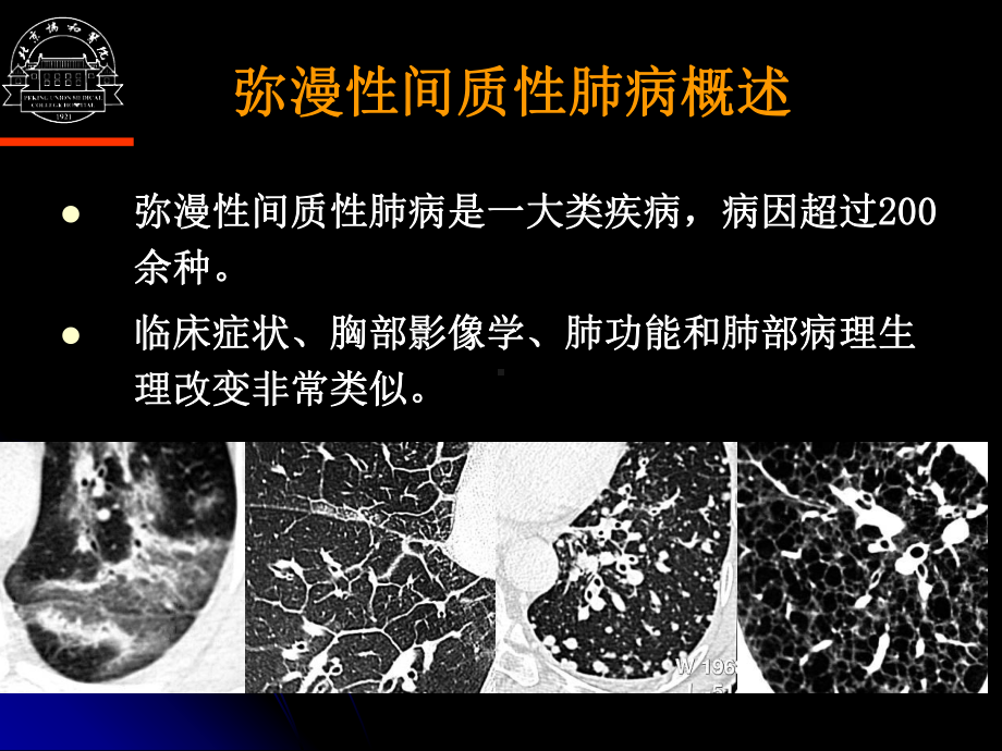 弥漫性间质性肺病诊断思路课件.ppt_第2页