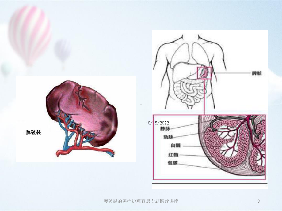 脾破裂的医疗护理查房专题医疗讲座培训课件.ppt_第3页