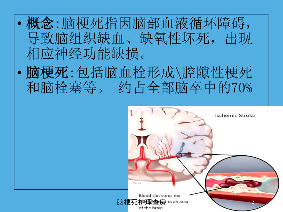 脑梗死护理查房培训课件.ppt_第2页