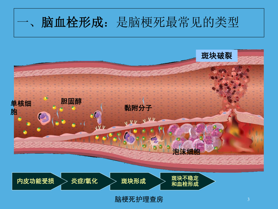 脑梗死护理查房培训课件.ppt_第3页