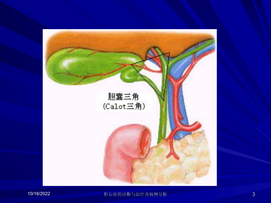 胆石症的诊断与治疗及病例分析培训课件.ppt_第3页