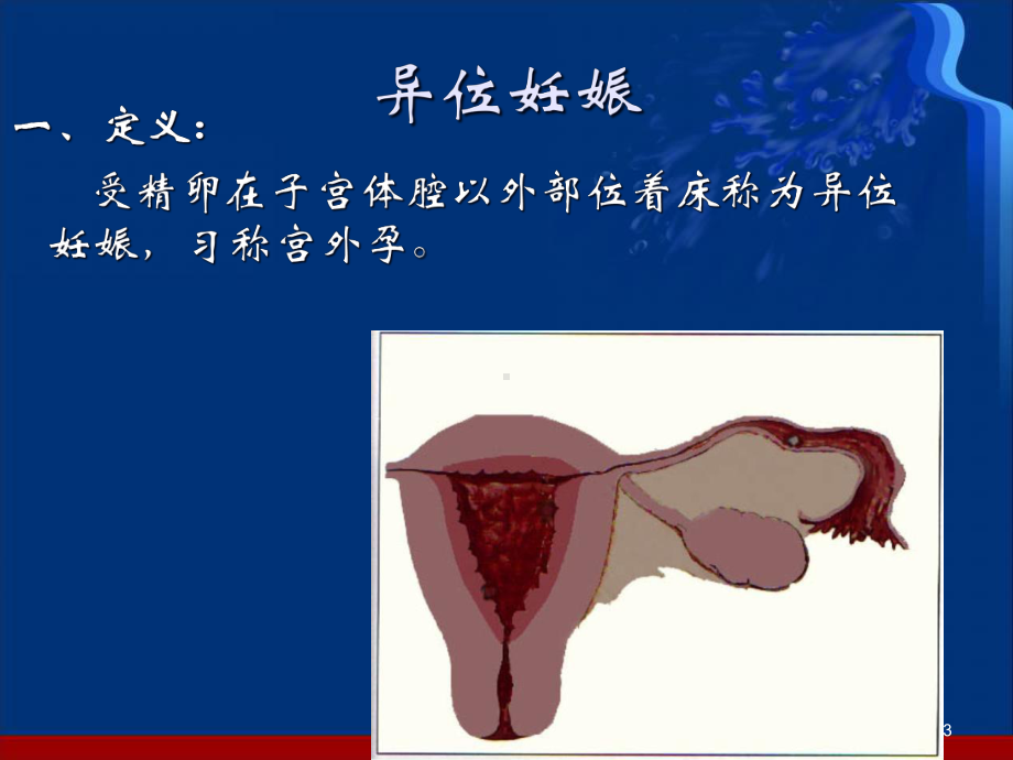 异位妊娠失血性休克的急救与护理(课堂)课件.ppt_第3页