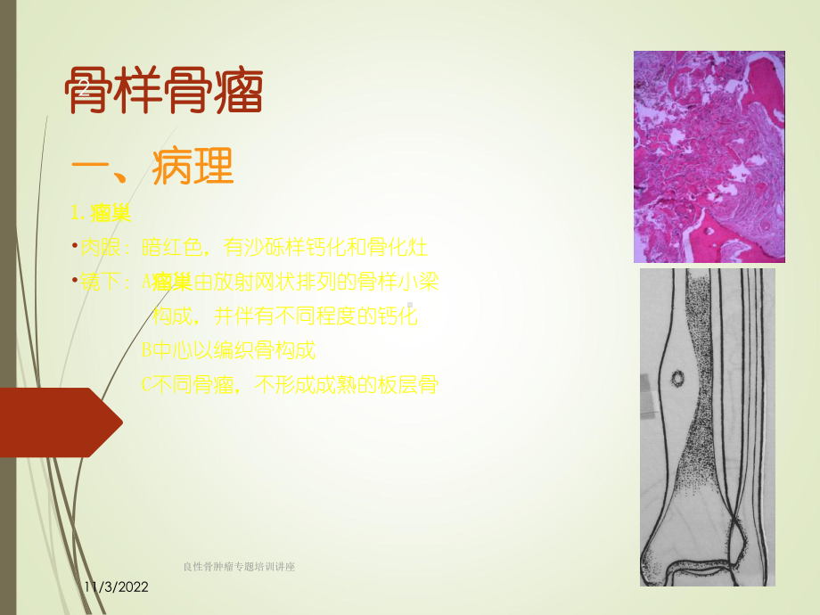 良性骨肿瘤专题培训讲座培训课件.ppt_第2页