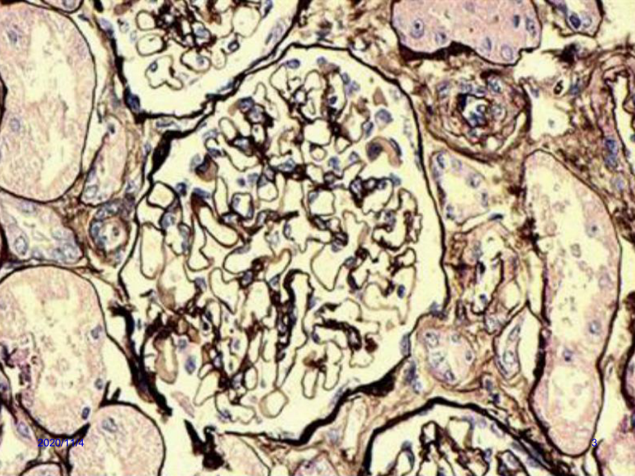 肾脏病理基础课件.ppt_第3页