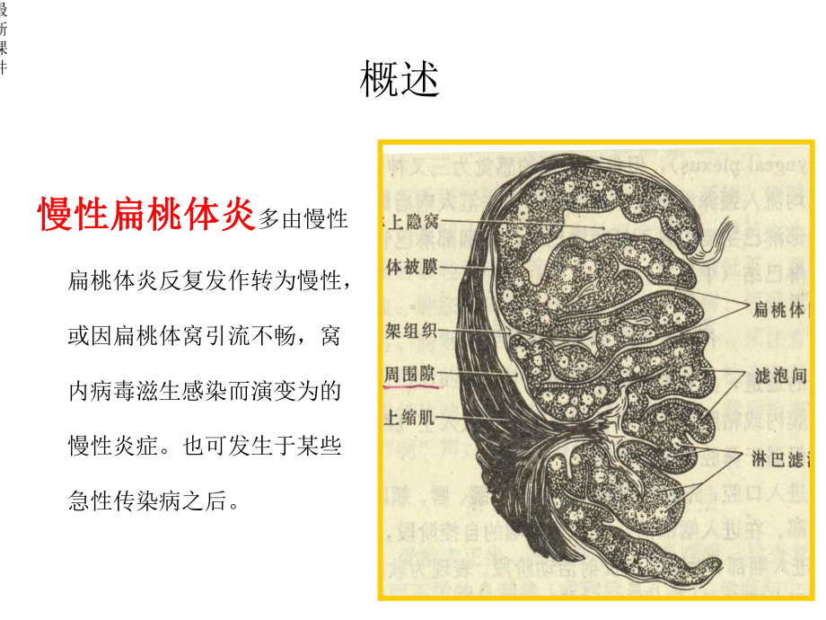 扁桃体摘除术课件.ppt_第2页