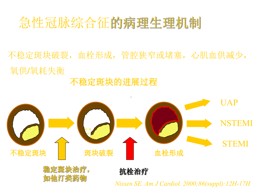 急性冠脉综合征的抗栓治疗课件.ppt_第3页