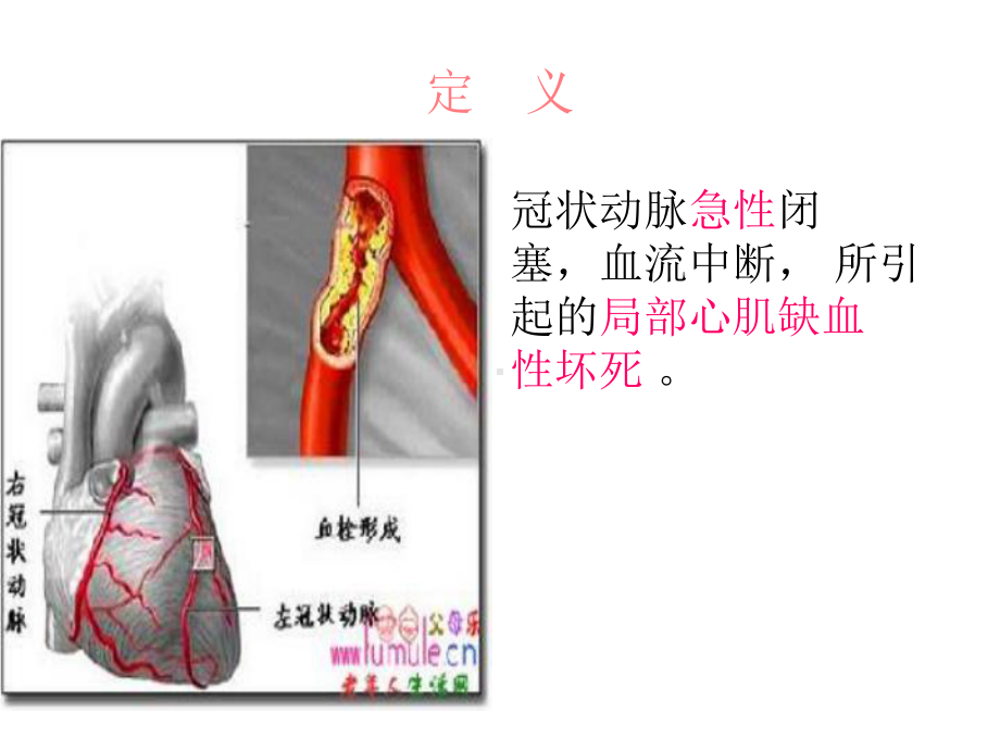 急性心肌梗死病人的护理查房课件.ppt_第3页