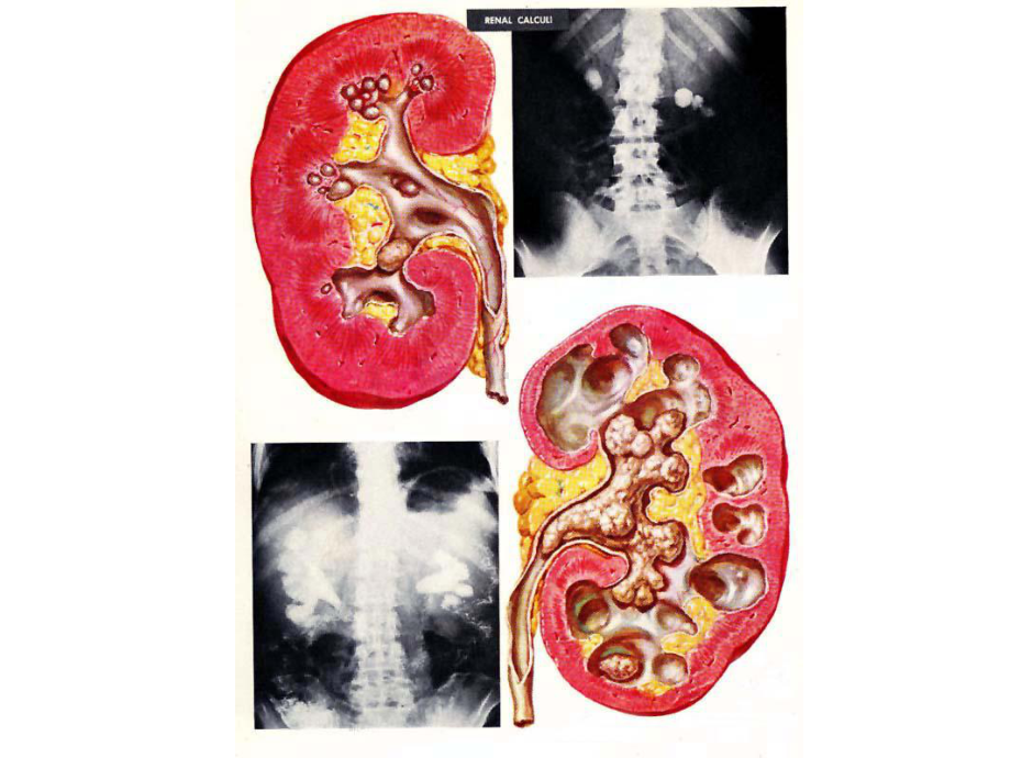 尿石症的现代观课件.ppt_第2页